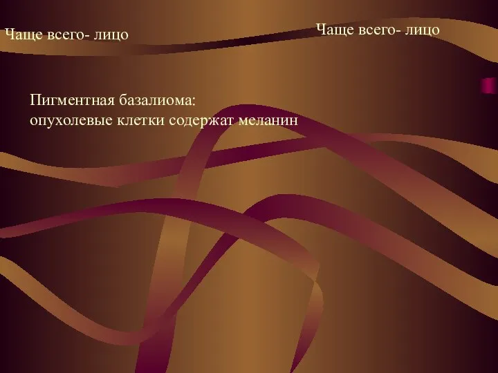 Чаще всего- лицо Чаще всего- лицо Пигментная базалиома: опухолевые клетки содержат меланин