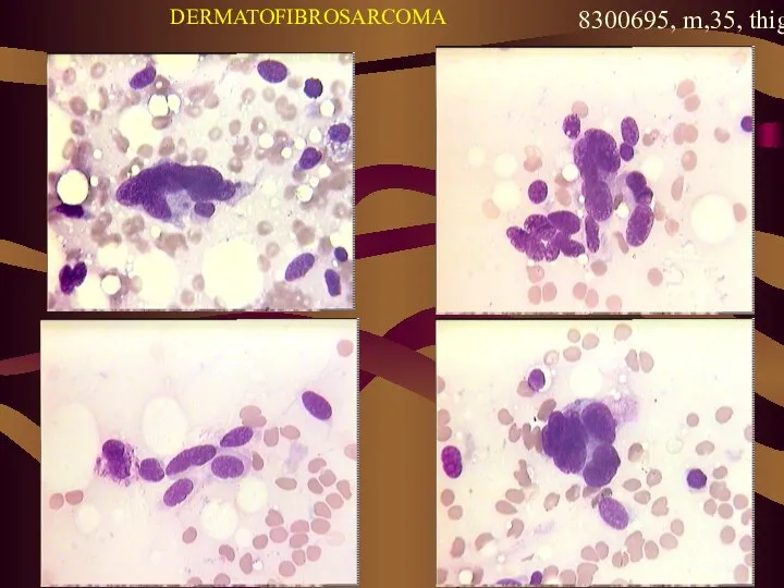 DERMATOFIBROSARCOMA 8300695, m,35, thigh