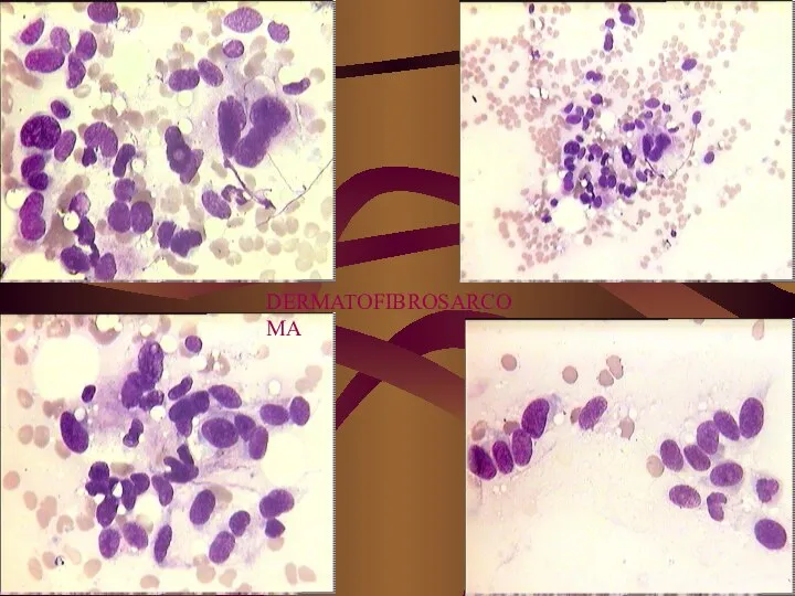 DERMATOFIBROSARCOMA