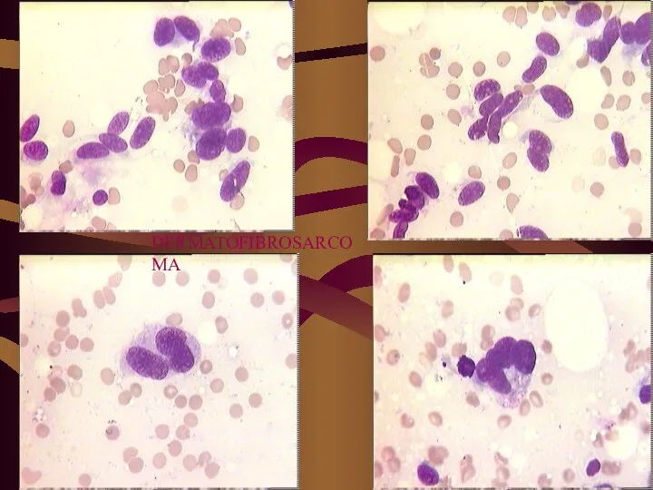 DERMATOFIBROSARCOMA