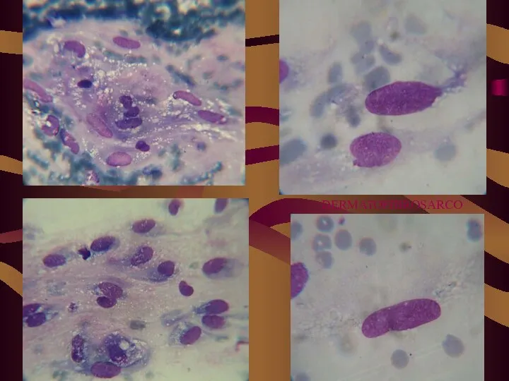 DERMATOFIBROSARCOMA