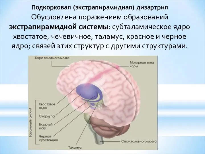 Подкорковая (экстрапирамидная) дизартрия Обусловлена поражением образований экстрапирамидной системы: субталамическое ядро хвостатое,