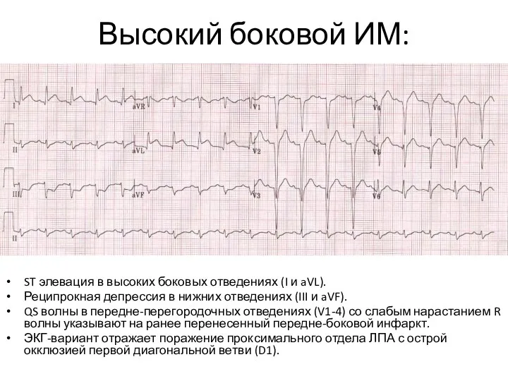 Высокий боковой ИМ: ST элевация в высоких боковых отведениях (I и