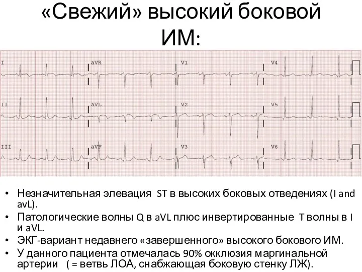 «Свежий» высокий боковой ИМ: Незначительная элевация ST в высоких боковых отведениях