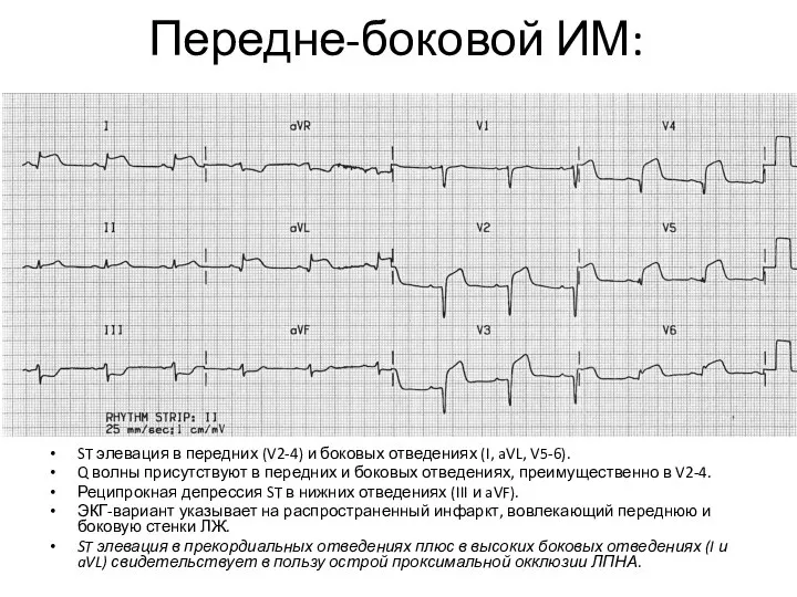 Передне-боковой ИМ: ST элевация в передних (V2-4) и боковых отведениях (I,