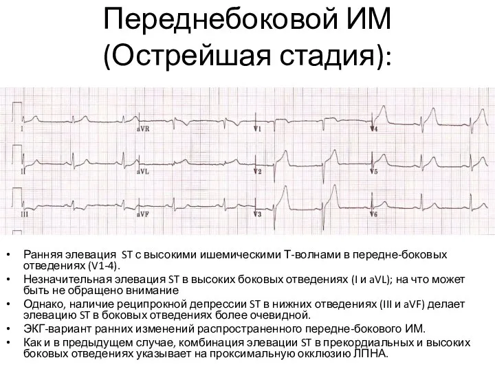 Переднебоковой ИМ (Острейшая стадия): Ранняя элевация ST с высокими ишемическими Т-волнами