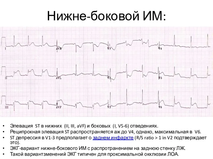 Нижне-боковой ИМ: Элевация ST в нижних (II, III, aVF) и боковых