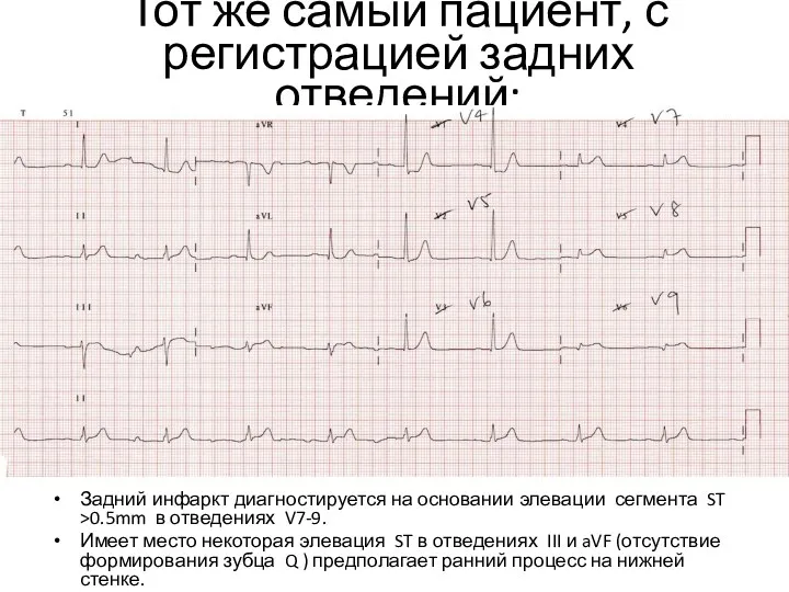 Тот же самый пациент, с регистрацией задних отведений: Задний инфаркт диагностируется