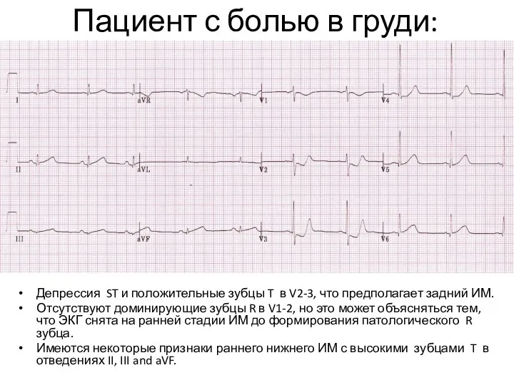 Пациент с болью в груди: Депрессия ST и положительные зубцы T