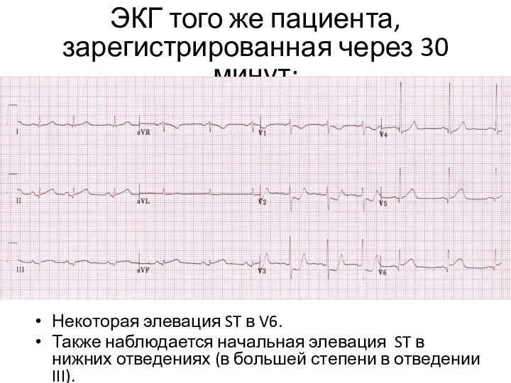 ЭКГ того же пациента, зарегистрированная через 30 минут: Некоторая элевация ST