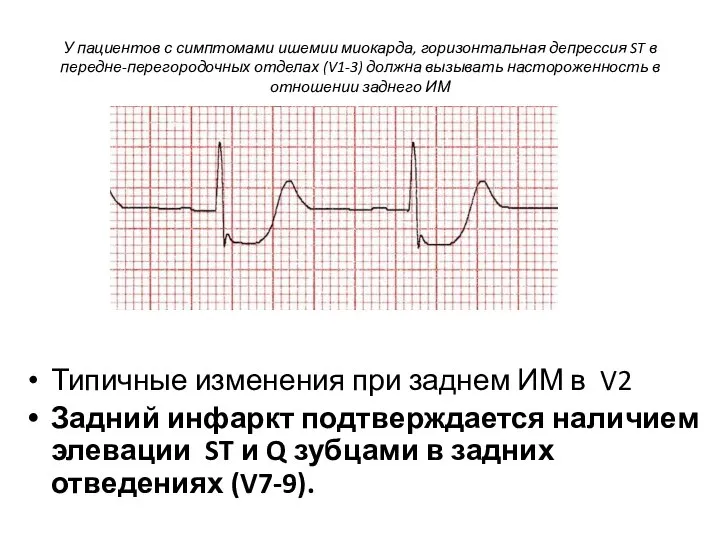 У пациентов с симптомами ишемии миокарда, горизонтальная депрессия ST в передне-перегородочных