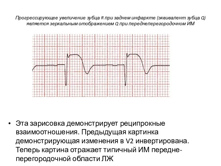 Прогрессирующее увеличение зубца R при заднем инфаркте (эквивалент зубца Q) является