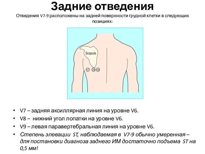 Задние отведения Отведения V7-9 расположены на задней поверхности грудной клетки в