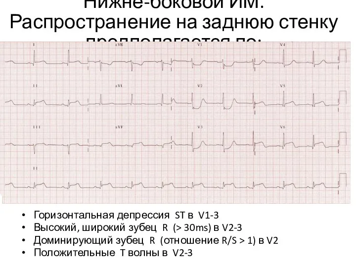 Нижне-боковой ИМ. Распространение на заднюю стенку предполагается по: Горизонтальная депрессия ST