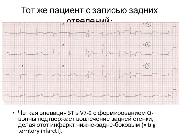 Тот же пациент с записью задних отведений: Четкая элевация ST в