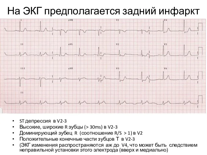 На ЭКГ предполагается задний инфаркт ST депрессия в V2-3 Высокие, широкие