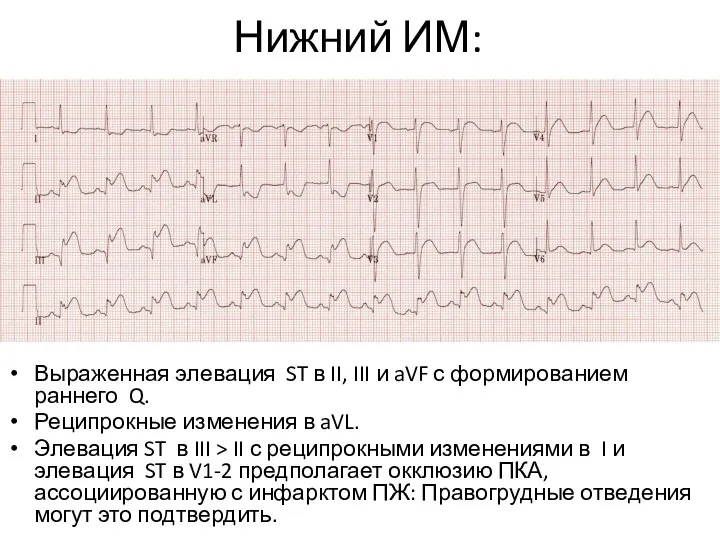 Нижний ИМ: Выраженная элевация ST в II, III и aVF с