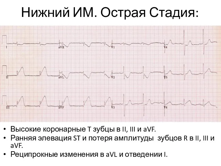 Нижний ИМ. Острая Стадия: Высокие коронарные T зубцы в II, III