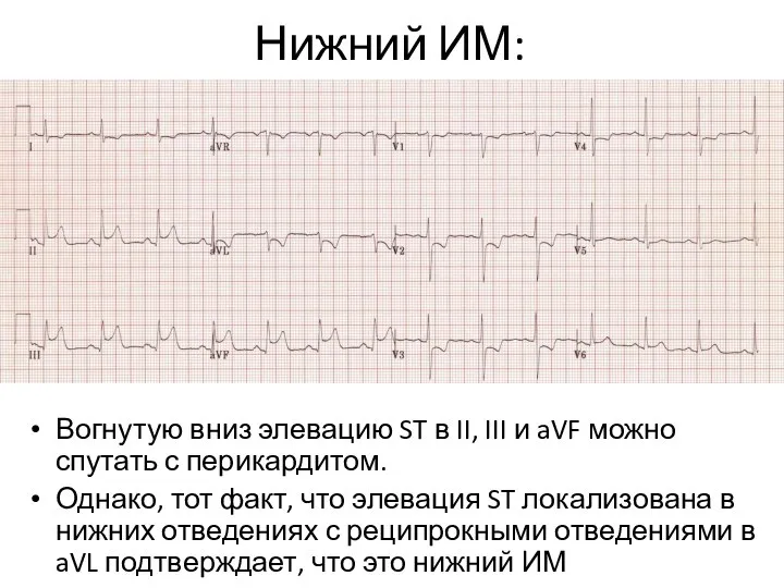 Нижний ИМ: Вогнутую вниз элевацию ST в II, III и aVF