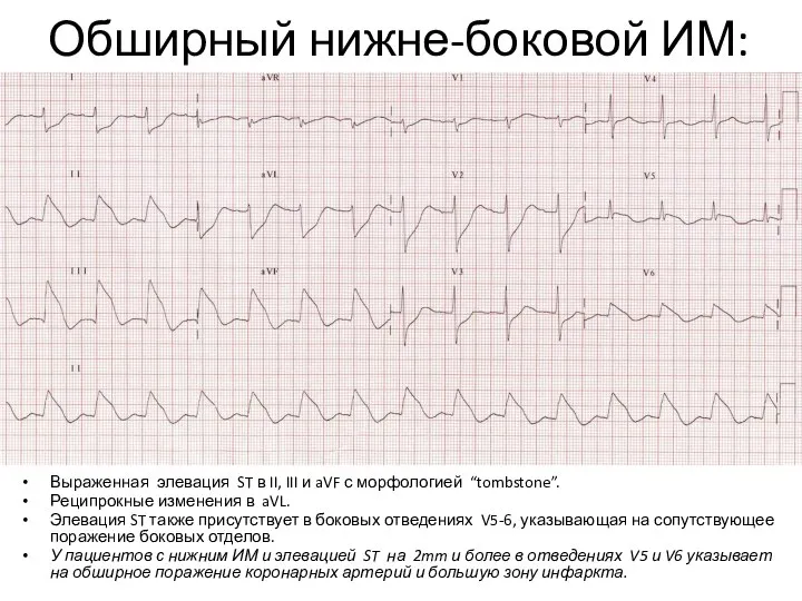 Обширный нижне-боковой ИМ: Выраженная элевация ST в II, III и aVF