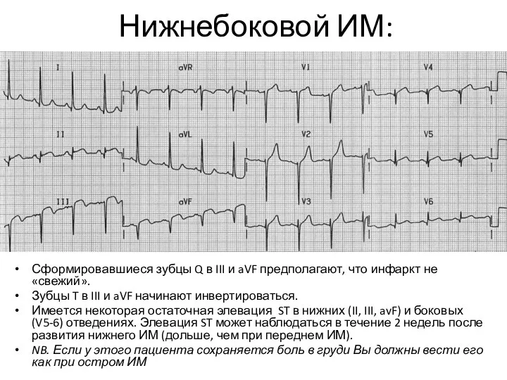 Нижнебоковой ИМ: Сформировавшиеся зубцы Q в III и aVF предполагают, что