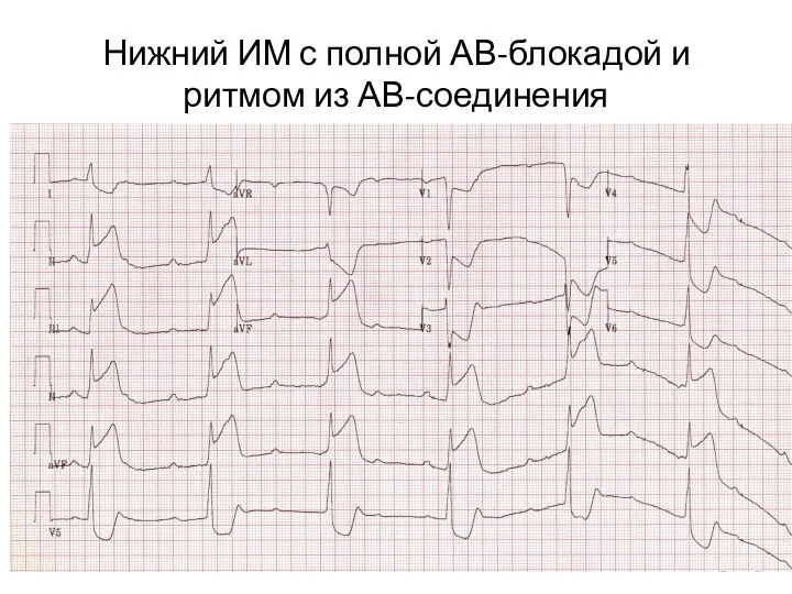 Нижний ИМ с полной АВ-блокадой и ритмом из АВ-соединения