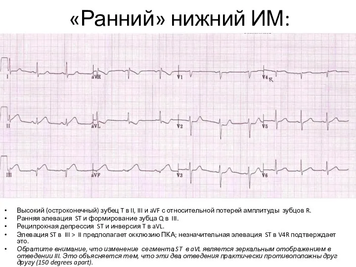 «Ранний» нижний ИМ: Высокий (остроконечный) зубец T в II, III и