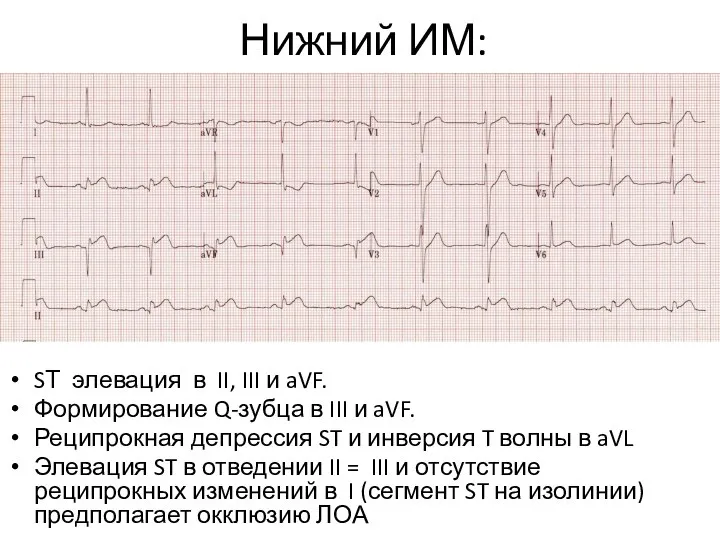 Нижний ИМ: SТ элевация в II, III и aVF. Формирование Q-зубца