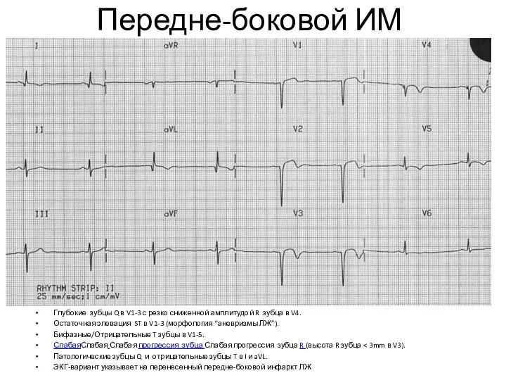 Передне-боковой ИМ Глубокие зубцы Q в V1-3 с резко сниженной амплитудой