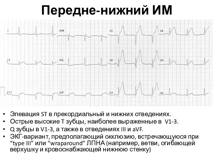 Передне-нижний ИМ Элевация ST в прекордиальный и нижних отведениях. Острые высокие