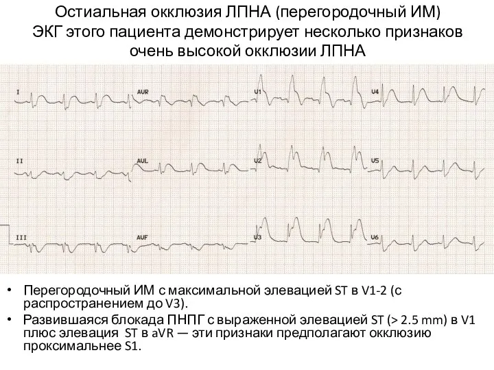 Остиальная окклюзия ЛПНА (перегородочный ИМ) ЭКГ этого пациента демонстрирует несколько признаков