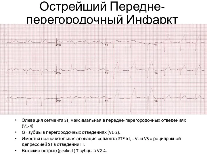 Острейший Передне-перегородочный Инфаркт Элевация сегмента ST, максимальная в передне-перегородочных отведениях (V1-4).