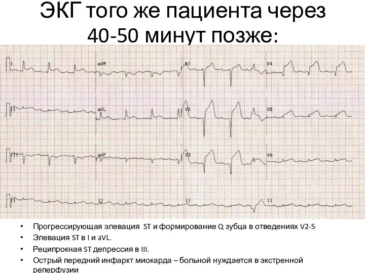 ЭКГ того же пациента через 40-50 минут позже: Прогрессирующая элевация ST