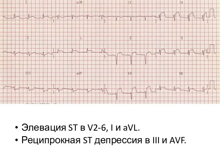 Элевация ST в V2-6, I и aVL. Реципрокная ST депрессия в III и AVF.