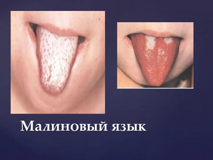 Малиновый язык