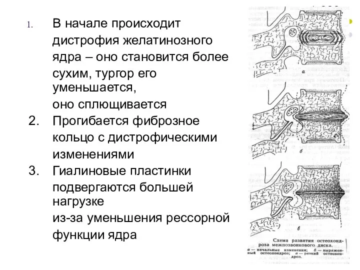 В начале происходит дистрофия желатинозного ядра – оно становится более сухим,