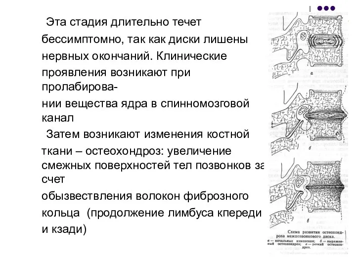 Эта стадия длительно течет бессимптомно, так как диски лишены нервных окончаний.