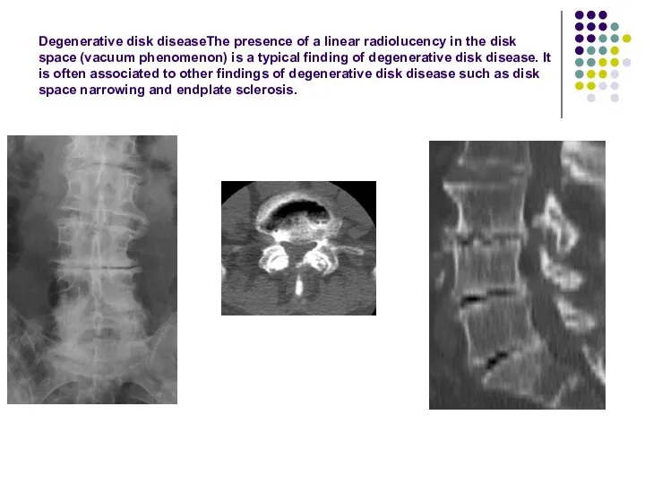 Degenerative disk diseaseThe presence of a linear radiolucency in the disk