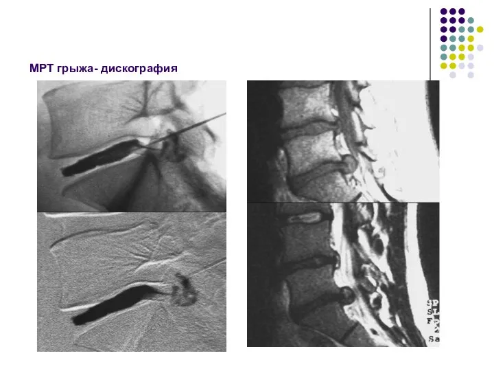 МРТ грыжа- дискография