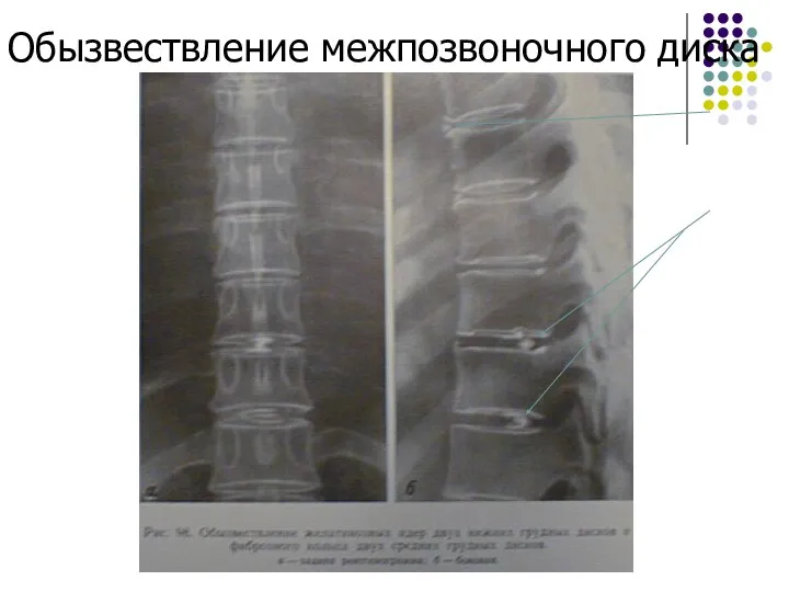 Обызвествление межпозвоночного диска