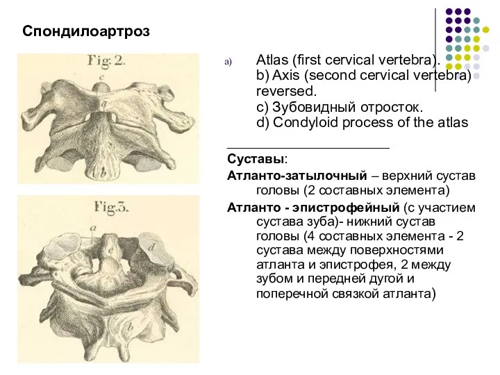 Спондилоартроз Atlas (first cervical vertebra). b) Axis (second cervical vertebra) reversed.