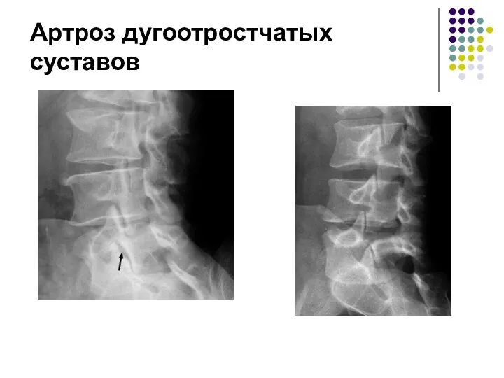 Артроз дугоотростчатых суставов