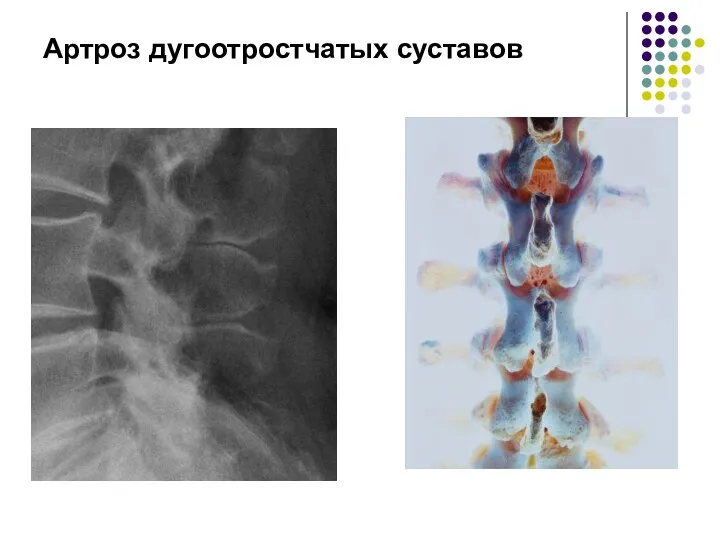 Артроз дугоотростчатых суставов