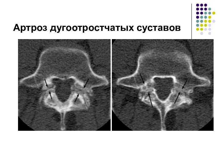 Артроз дугоотростчатых суставов