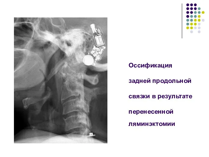 Оссификация задней продольной связки в результате перенесенной ляминэктомии