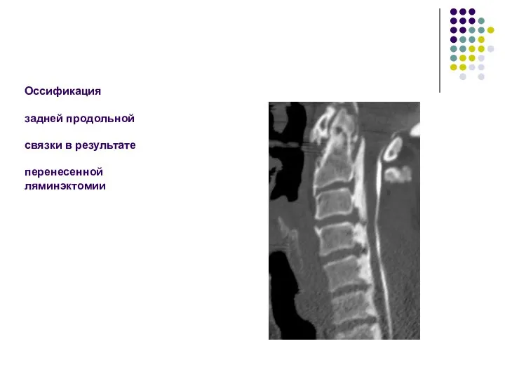Оссификация задней продольной связки в результате перенесенной ляминэктомии
