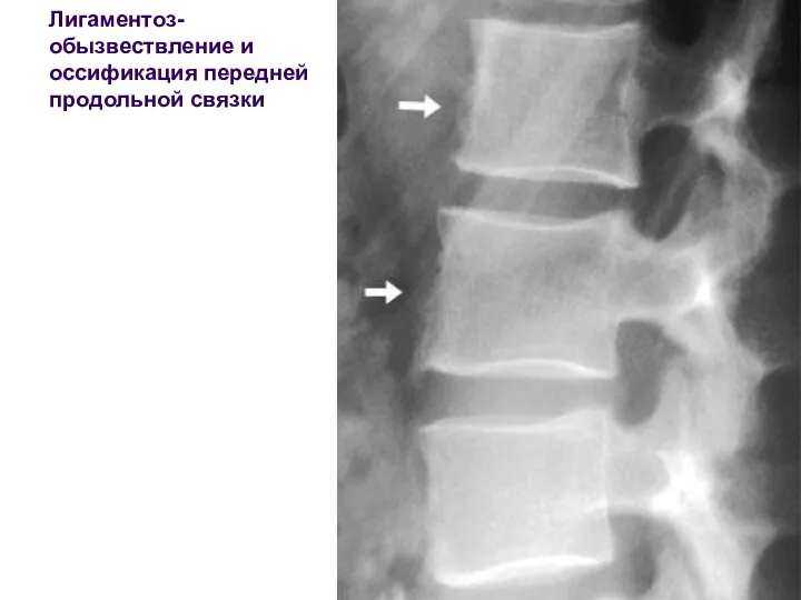 Лигаментоз- обызвествление и оссификация передней продольной связки