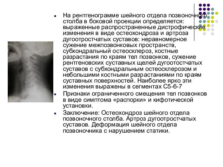 На рентгенограмме шейного отдела позвоночного столба в боковой проекции определяется: выраженные