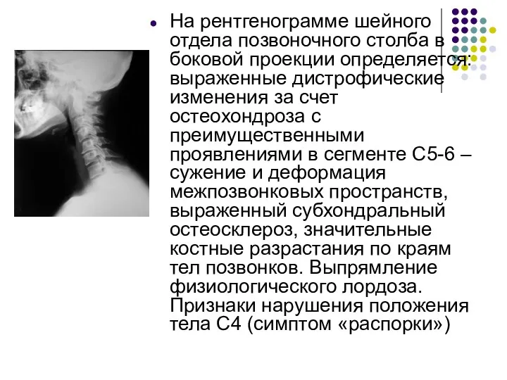 На рентгенограмме шейного отдела позвоночного столба в боковой проекции определяется: выраженные