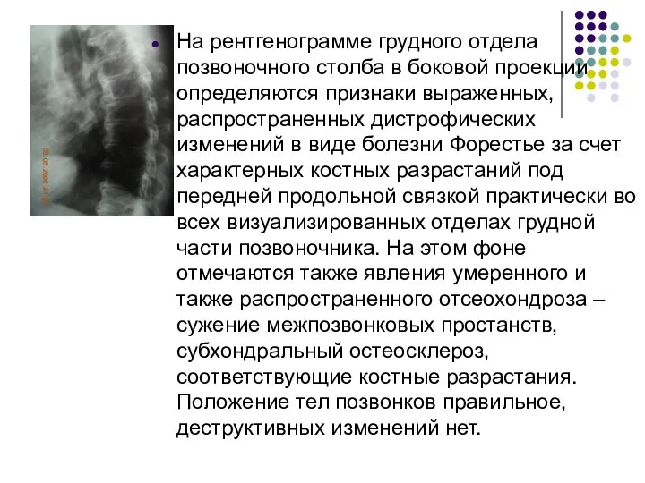 На рентгенограмме грудного отдела позвоночного столба в боковой проекции определяются признаки